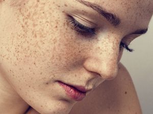 Tratamento de manchas na pele: por onde eu comecei?