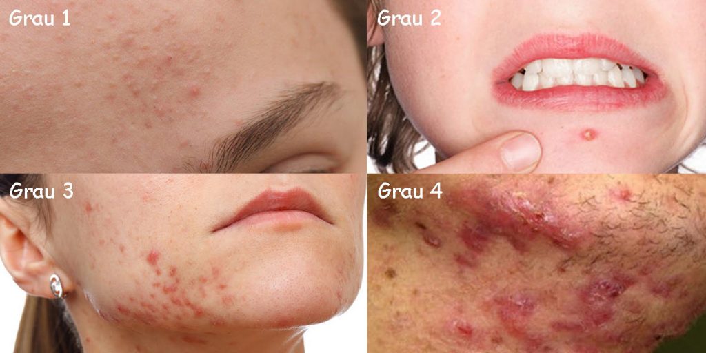 Graus Da Acne Conhe A A Causa E Os Tratamentos Dicas Da Jaque